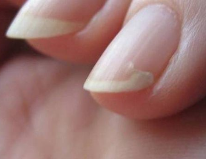 🩺 Оніхолізис: причини, лікування та профілактика