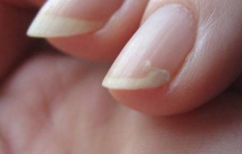 🩺 Оніхолізис: причини, лікування та профілактика